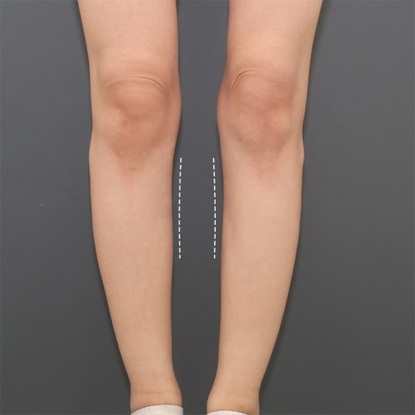 오다리 교정 필러