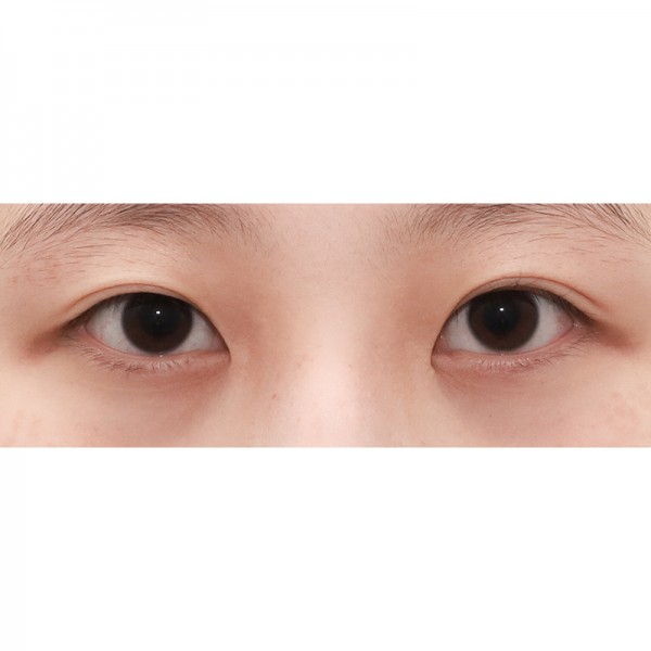 자연유착+눈매교정+듀얼트임(앞/위)