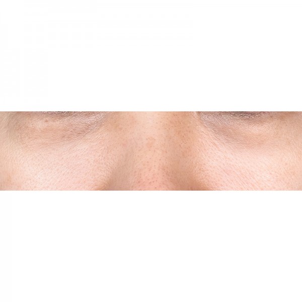 눈밑지방재배치