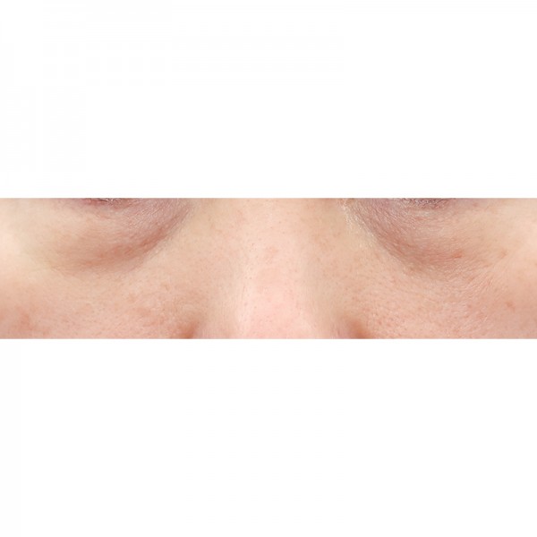 눈밑지방재배치