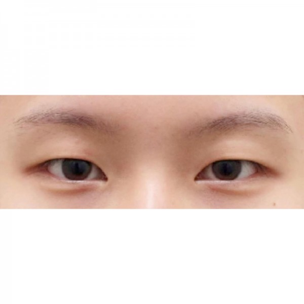 자연유착+눈매교정