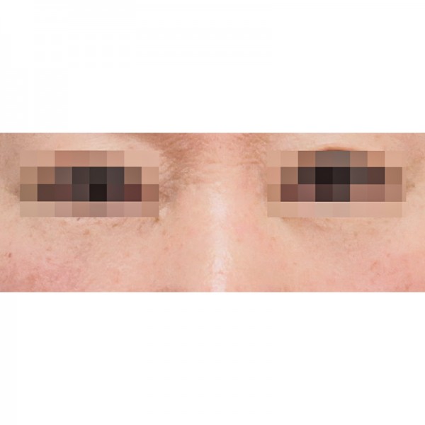 눈밑지방재배치