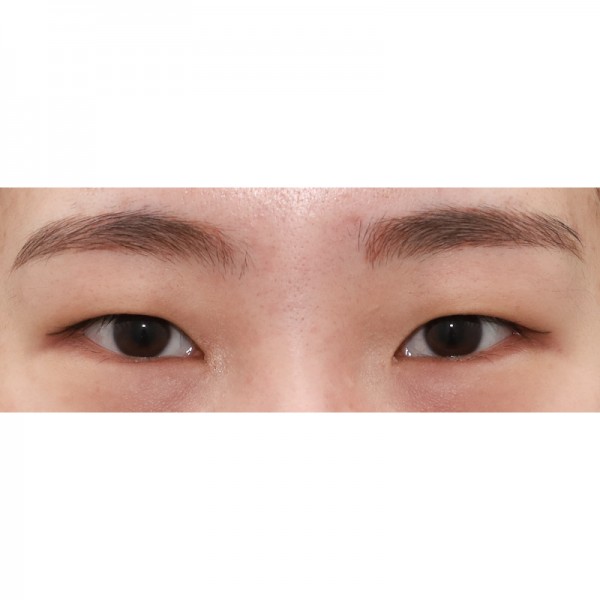 절개 쌍꺼풀