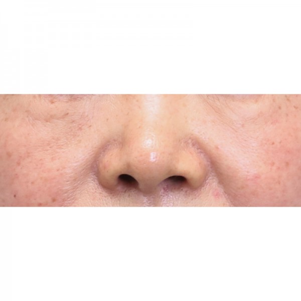 눈밑지방재배치